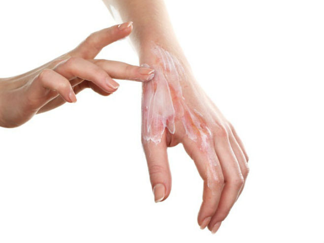 Опекотине на руци (Фото: Shutterstock) - 